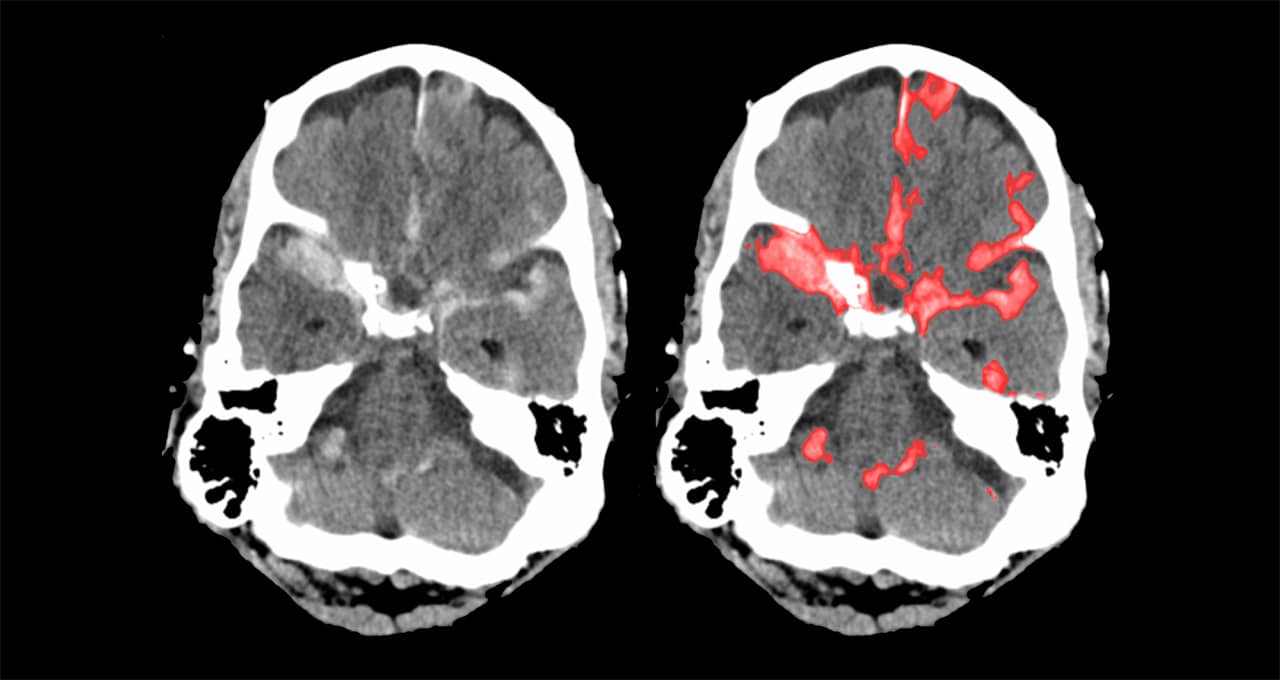 deep learning brain hemorrhages